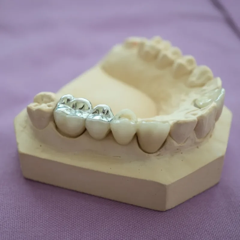 Diş Dolgusu Türleri