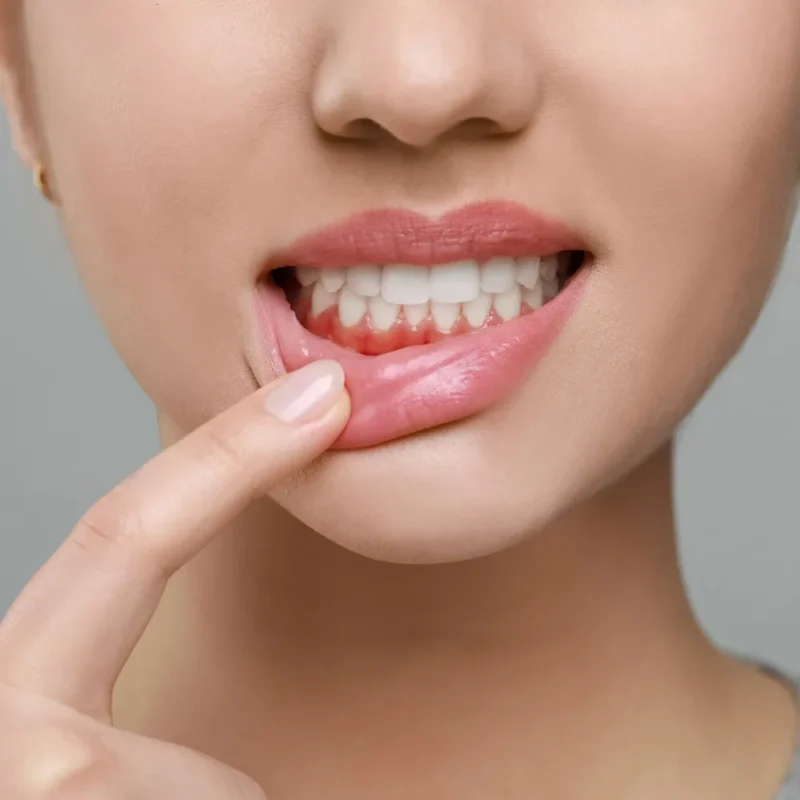 Diş Eti Hastalıkları