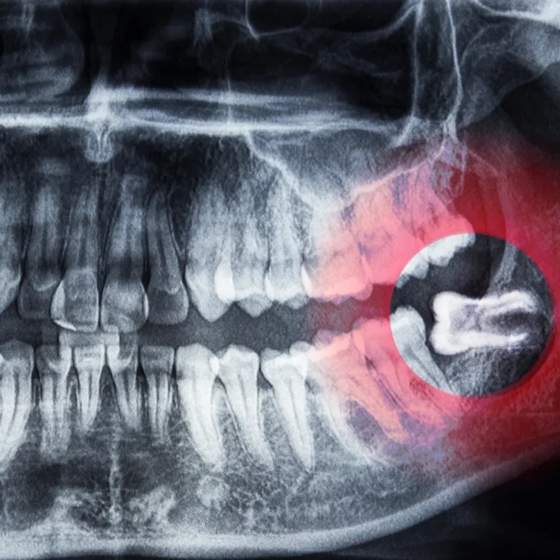 Diyarbakır 20'lik Diş Çekimi Fiyatları