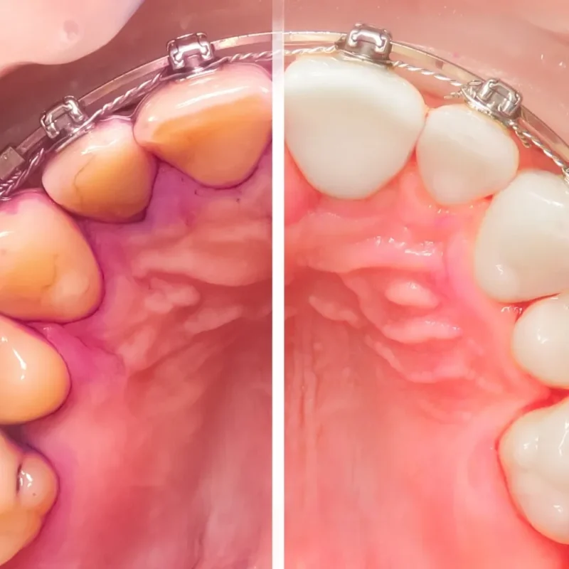 Diyarbakır Diş Taşı Temizliği Fiyatları