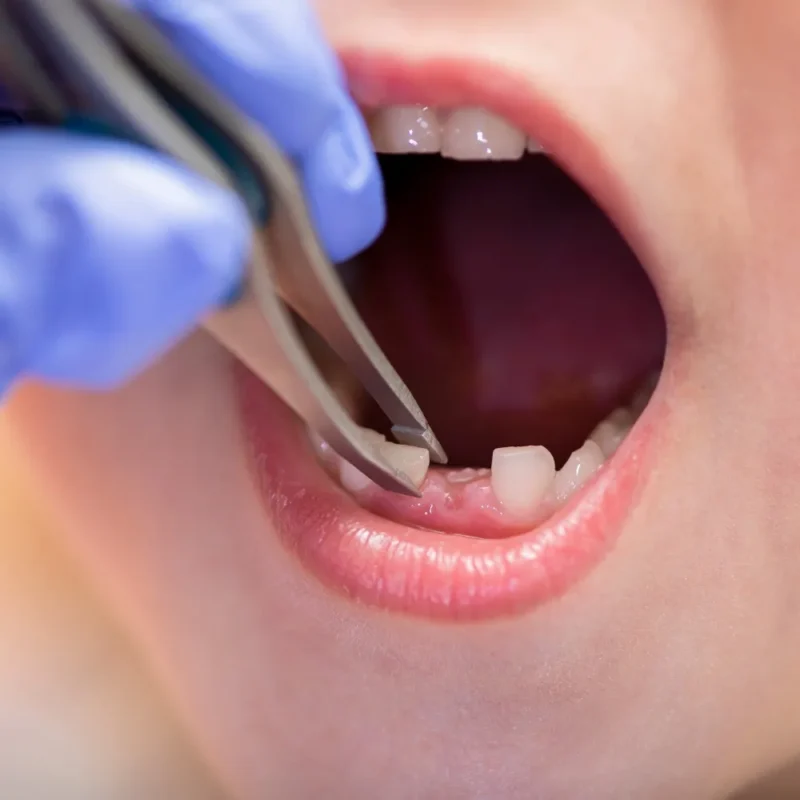 Süt Dişi Çekimi Fiyatları