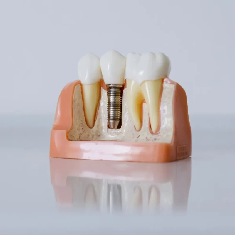 Tek Diş İmplant